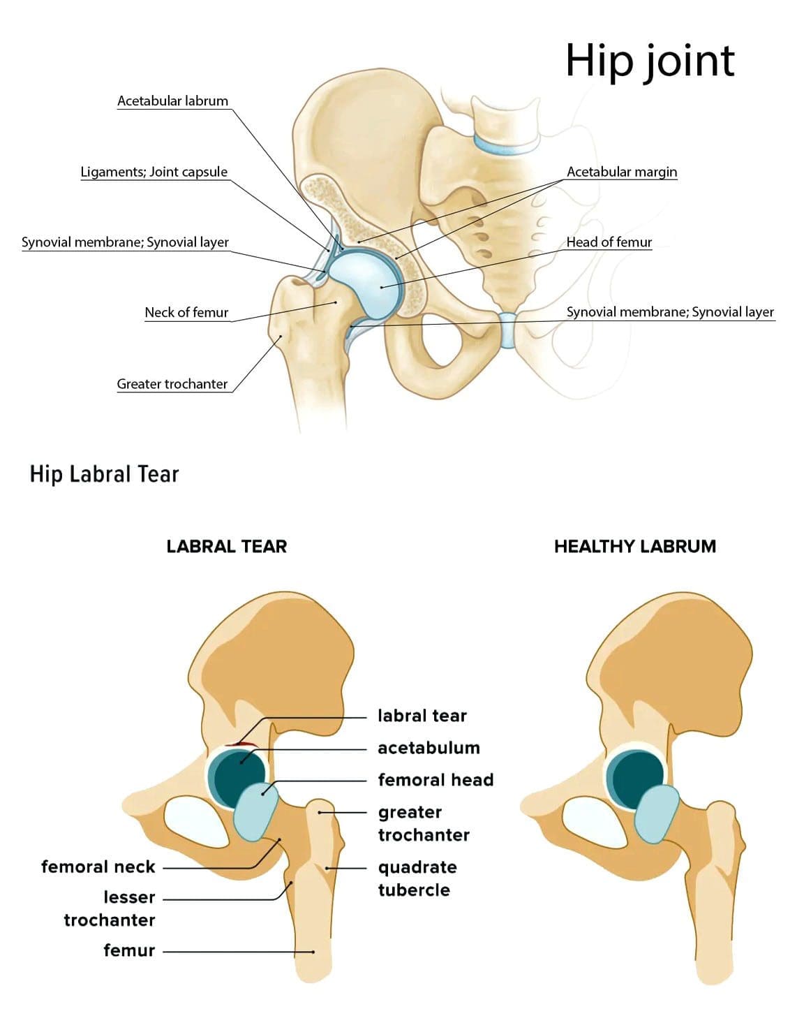 Test di lacerazione labrale dell'anca: squadra di chiropratica EP