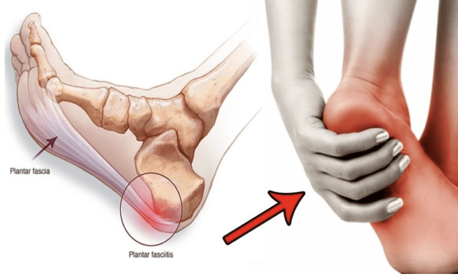 Learn About Plantar Fasciitis Flare-Ups & Treatments