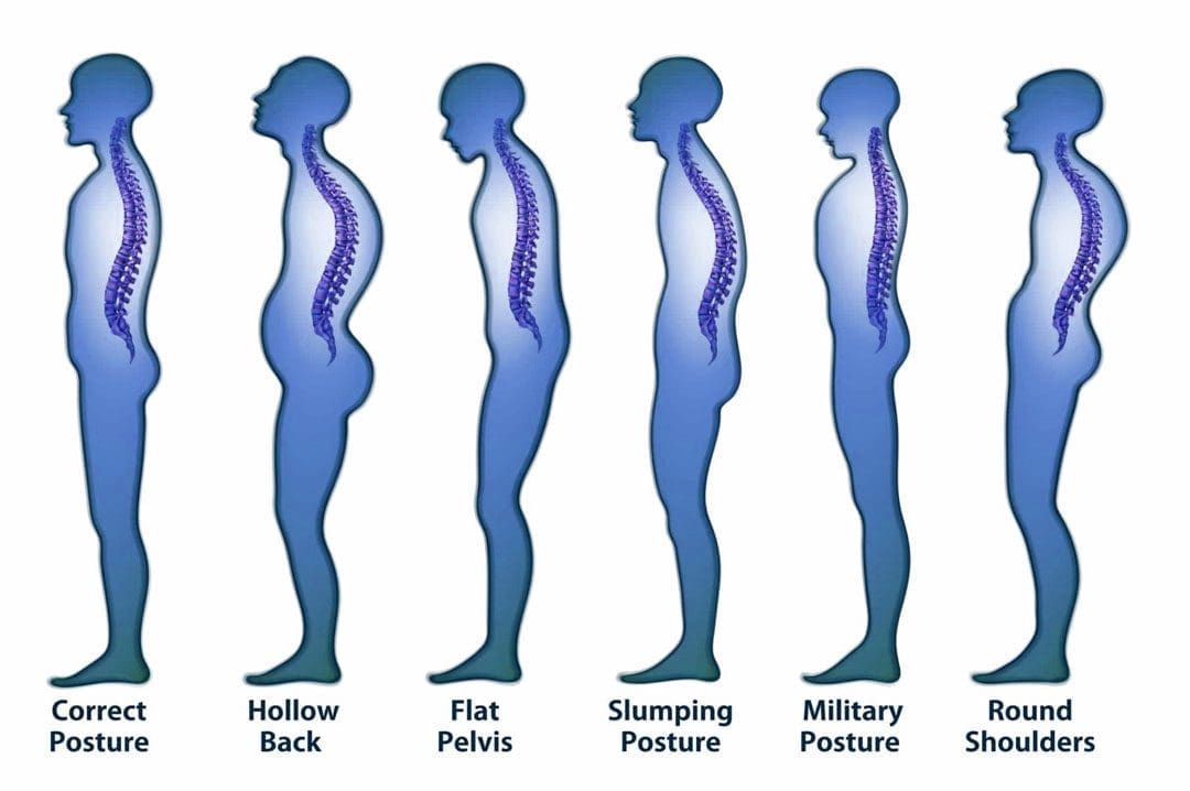 Slouching Causes: EP's Chiropractic Functional Medicine Team