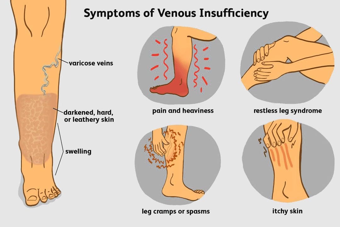 Venous Insufficiency: EP Chiropractic Functional Medicine Clinic