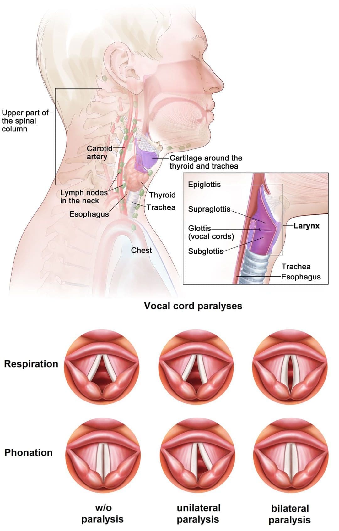 Lesioni alle corde vocali: specialisti in lesioni chiropratiche EP
