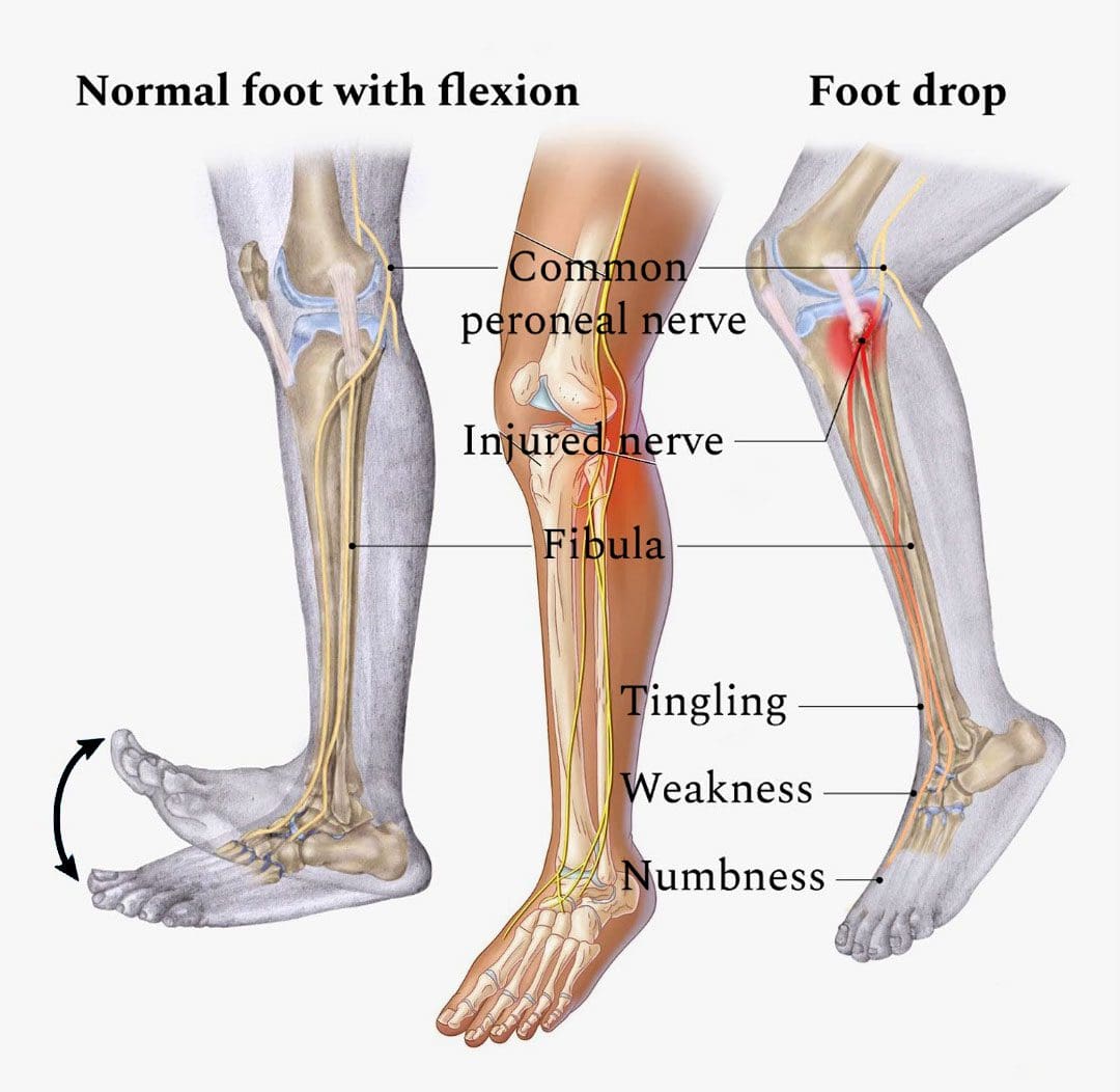 Peroneal Nerve Injury: EP's Chiropractic Team