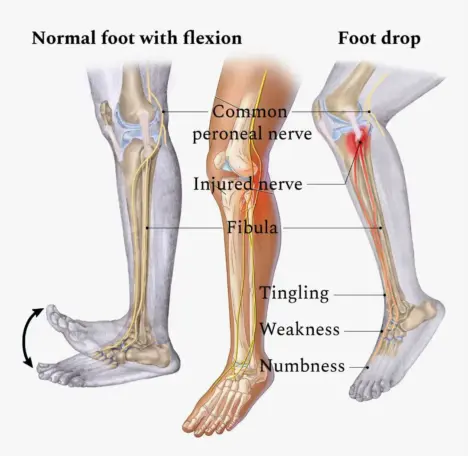 Peroneal Nerve Injury EP s Chiropractic Team peroneal-nerve-injury-ep-s-chiropractic-team