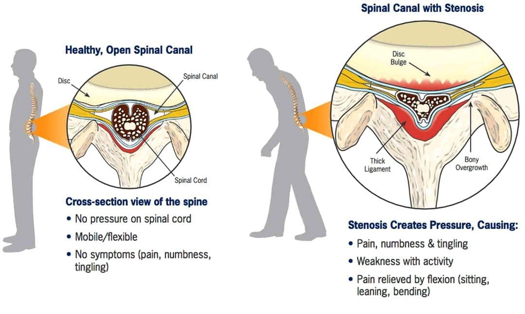 Spinal Stenosis Physical Therapy: A Guide to Relief