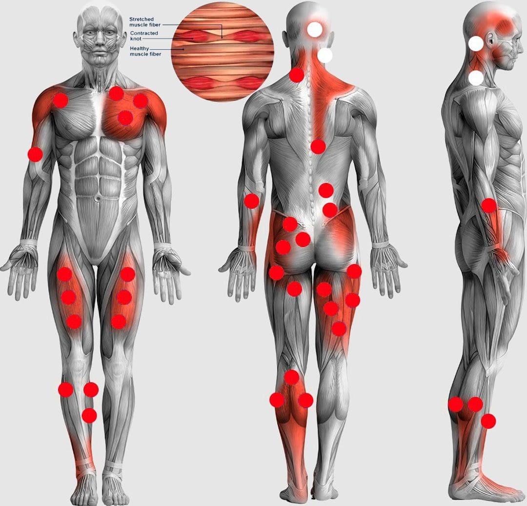 Muscle Knots - Trigger Points: EP's Chiropractic Team