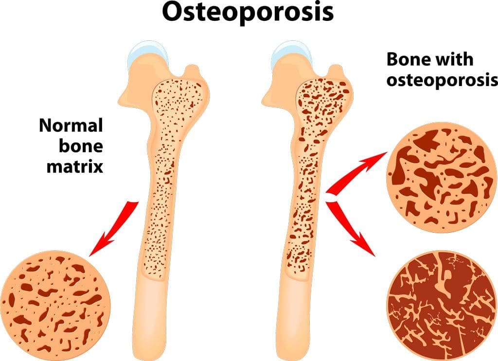 Enhance Your Bone Strength: Reduce the Risk of Fractures