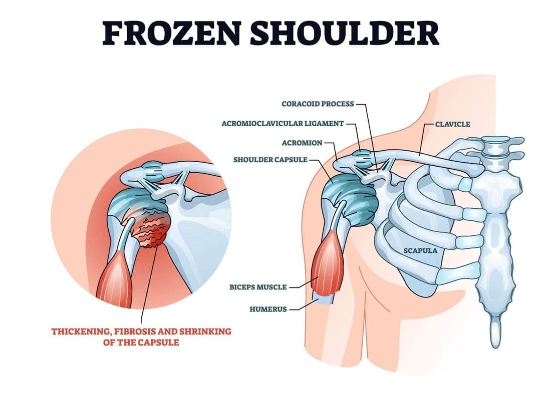 Stiffness and Pain Developing In The Shoulder