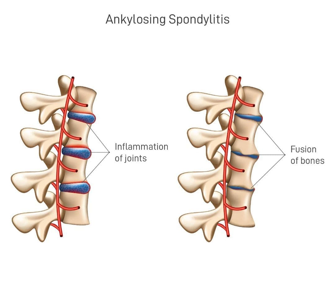 Understanding Ankylosing Spondylitis: The Impact on Posture