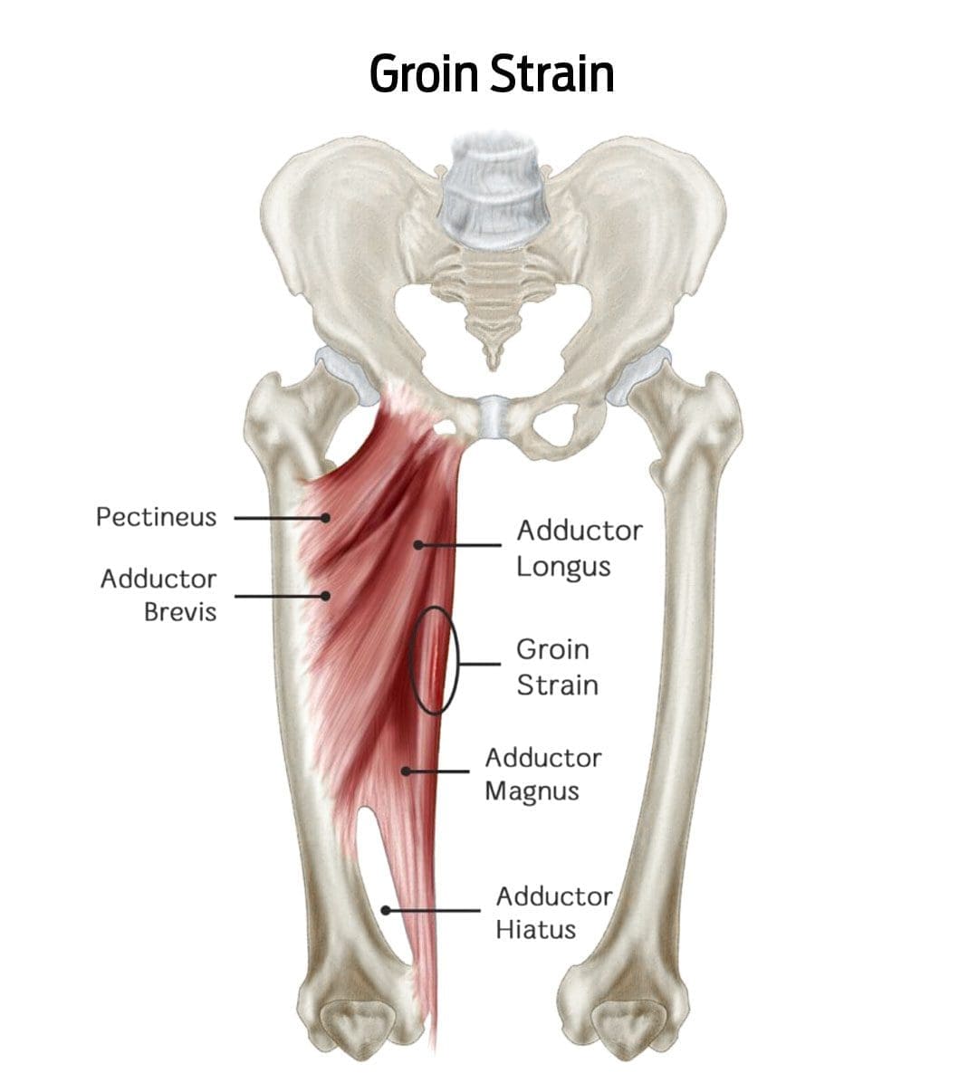 Healing a Groin Strain: A Comprehensive Guide