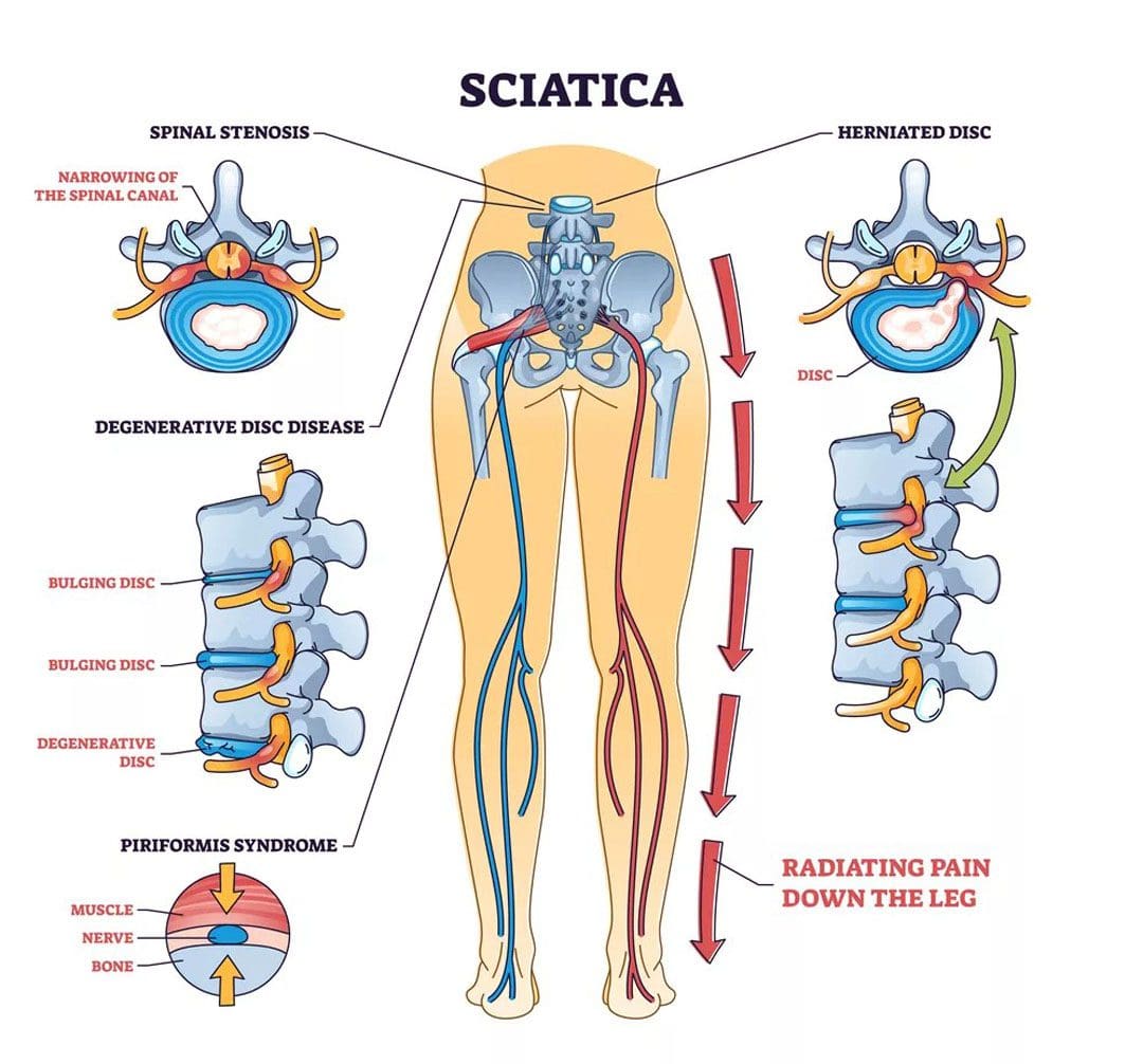 Chronic Sciatica: Causes, Symptoms & Treatment