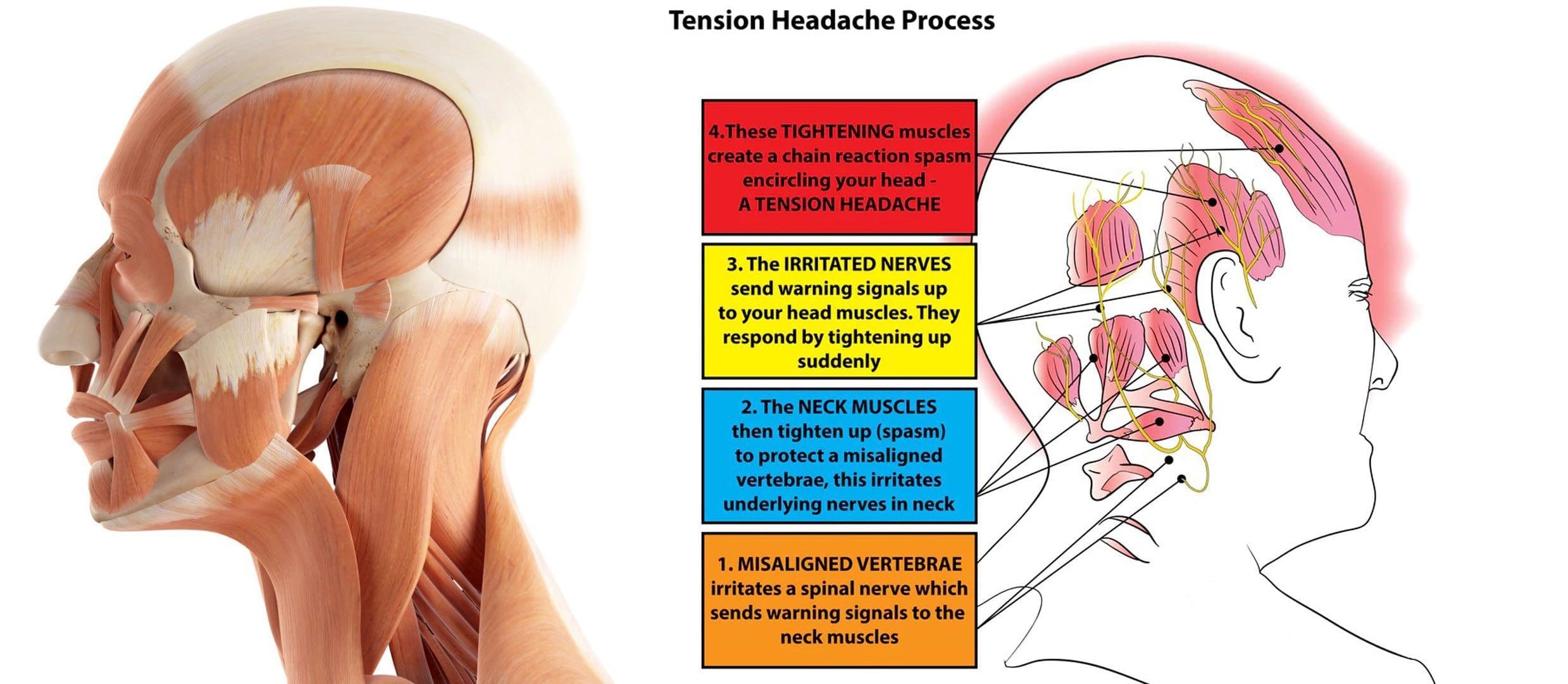 Managing Chronic Tension Headaches: A Step-by-Step Guide