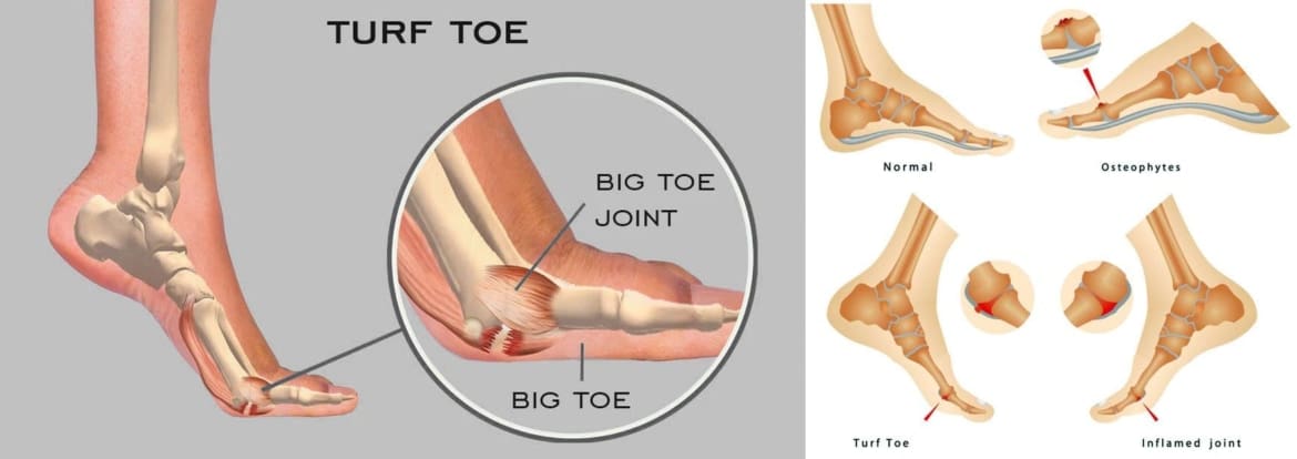 A Comprehensive Guide to Turf Toe Injury Recovery - El Paso, TX Doctor ...