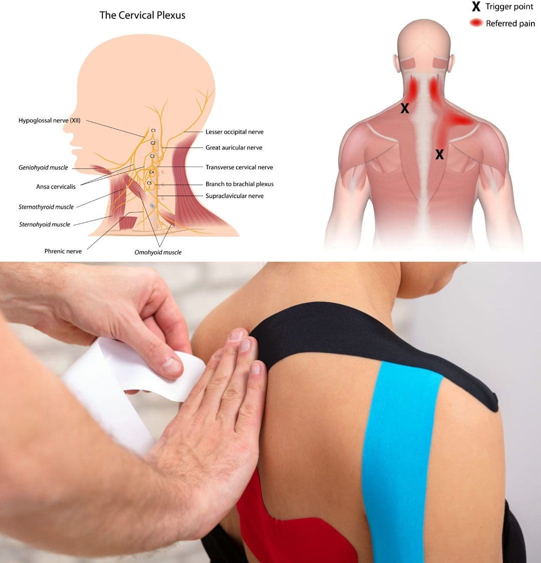 Kinesiology Tape for Neck and Shoulder Pain Relief: a Guide