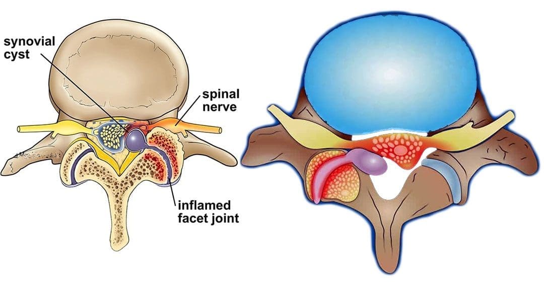 Spinal Synovial Cysts: Causes, Symptoms & Treatment Options