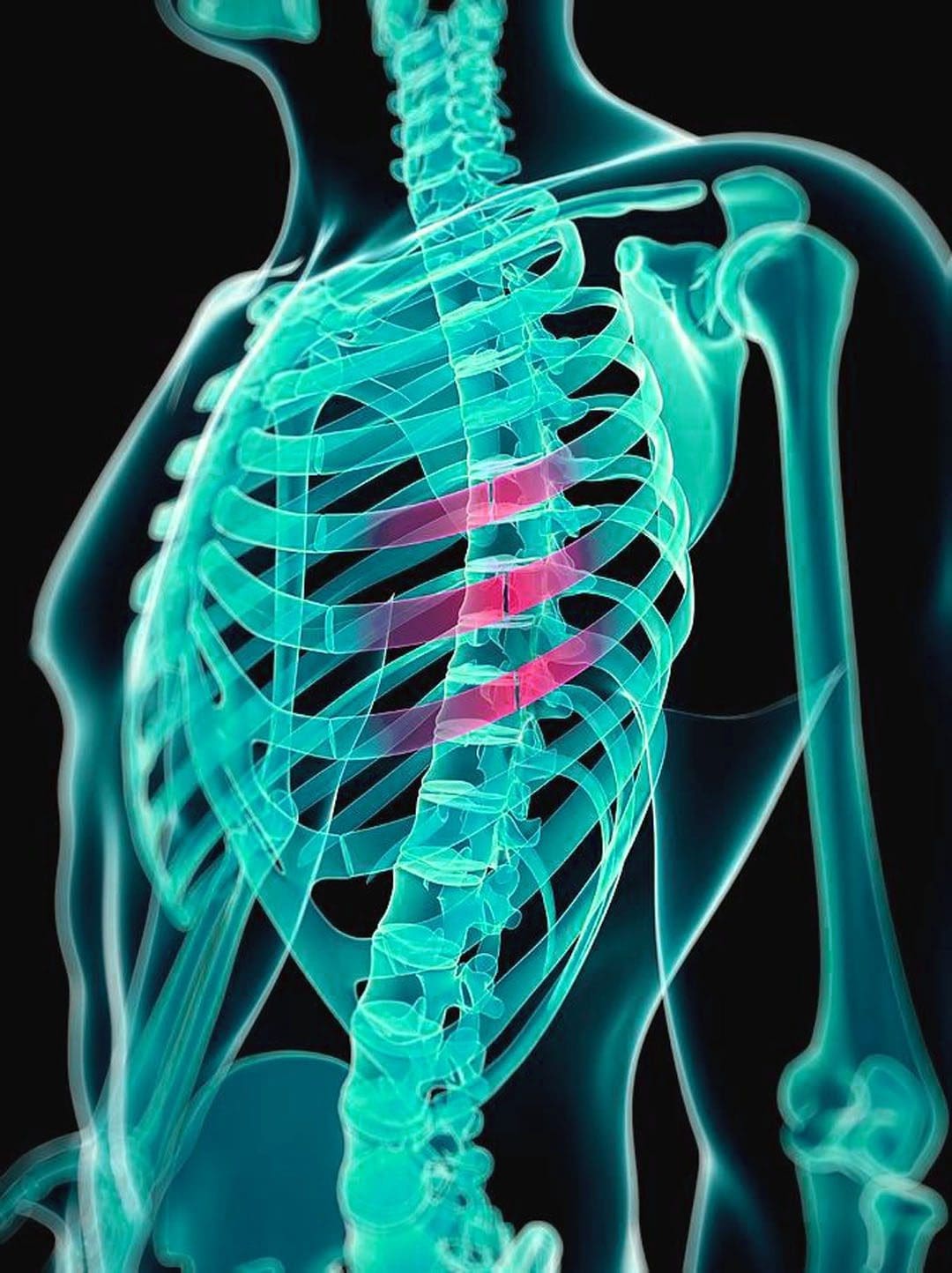 Recognizing the Symptoms of a Cracked Rib