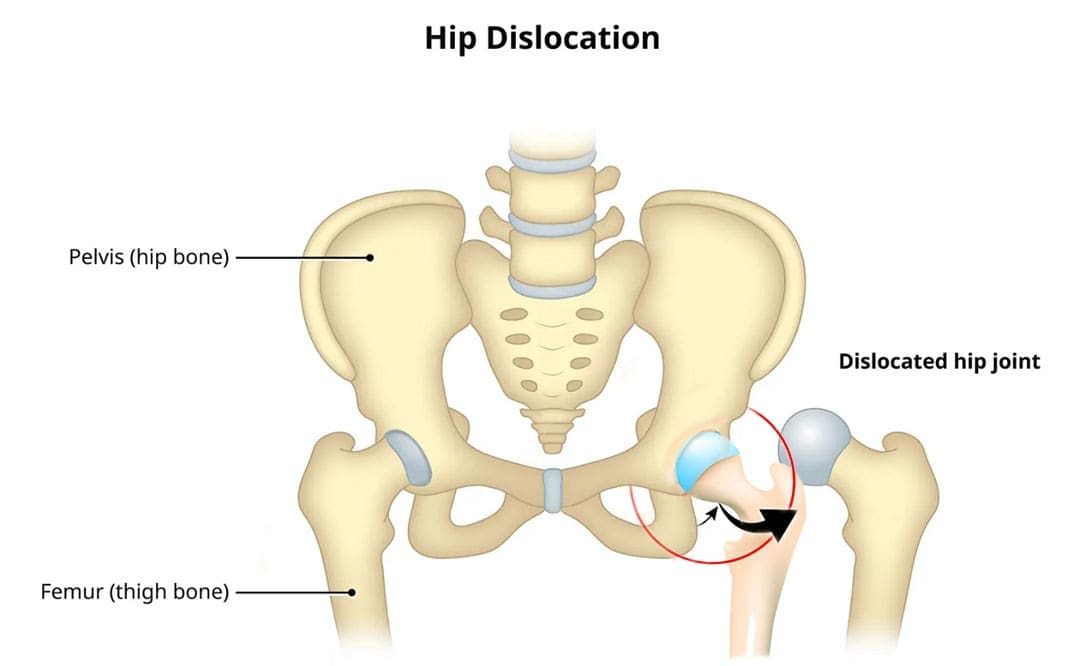 Verstinn vun enger dislokéierter Hip: Ursaachen, Behandlung an Erhuelung