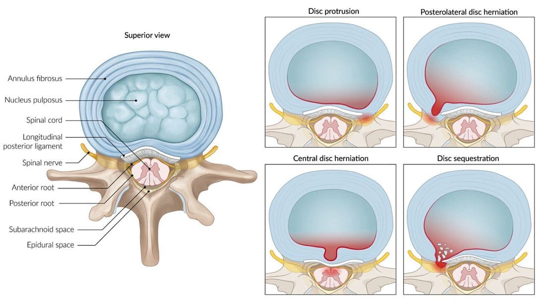 The Role of Nucleus Pulposus in Spinal Shock Absorption