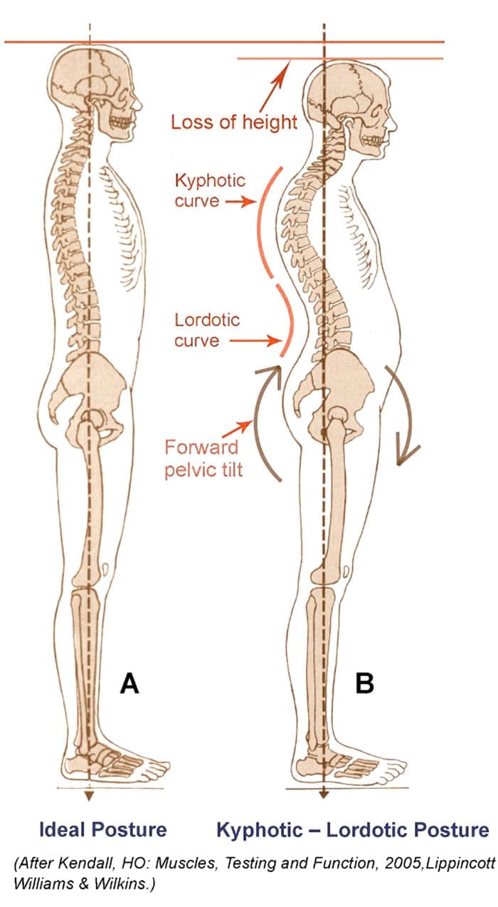 Swayback Posture: Identifying and Treating the Issue