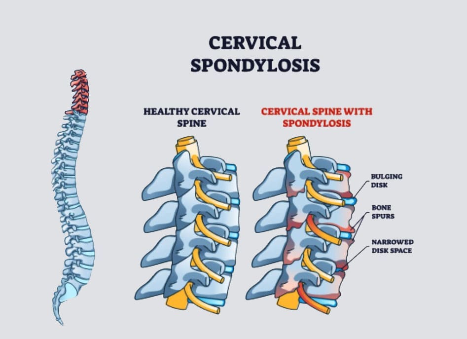 Cervical Arthritis: Managing Neck Pain and Stiffness