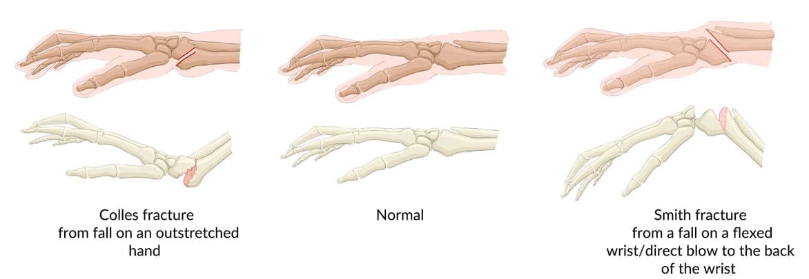 Understanding Colles' Fracture: Causes and Treatment