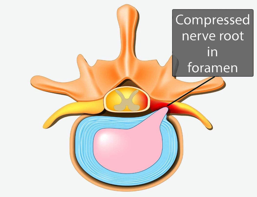 Surgical Decompression: A Solution for Nerve Root Encroachment