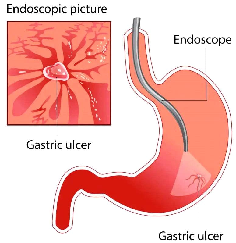 Peptic Ulcers and NSAIDs: Causes, Symptoms, and Prevention