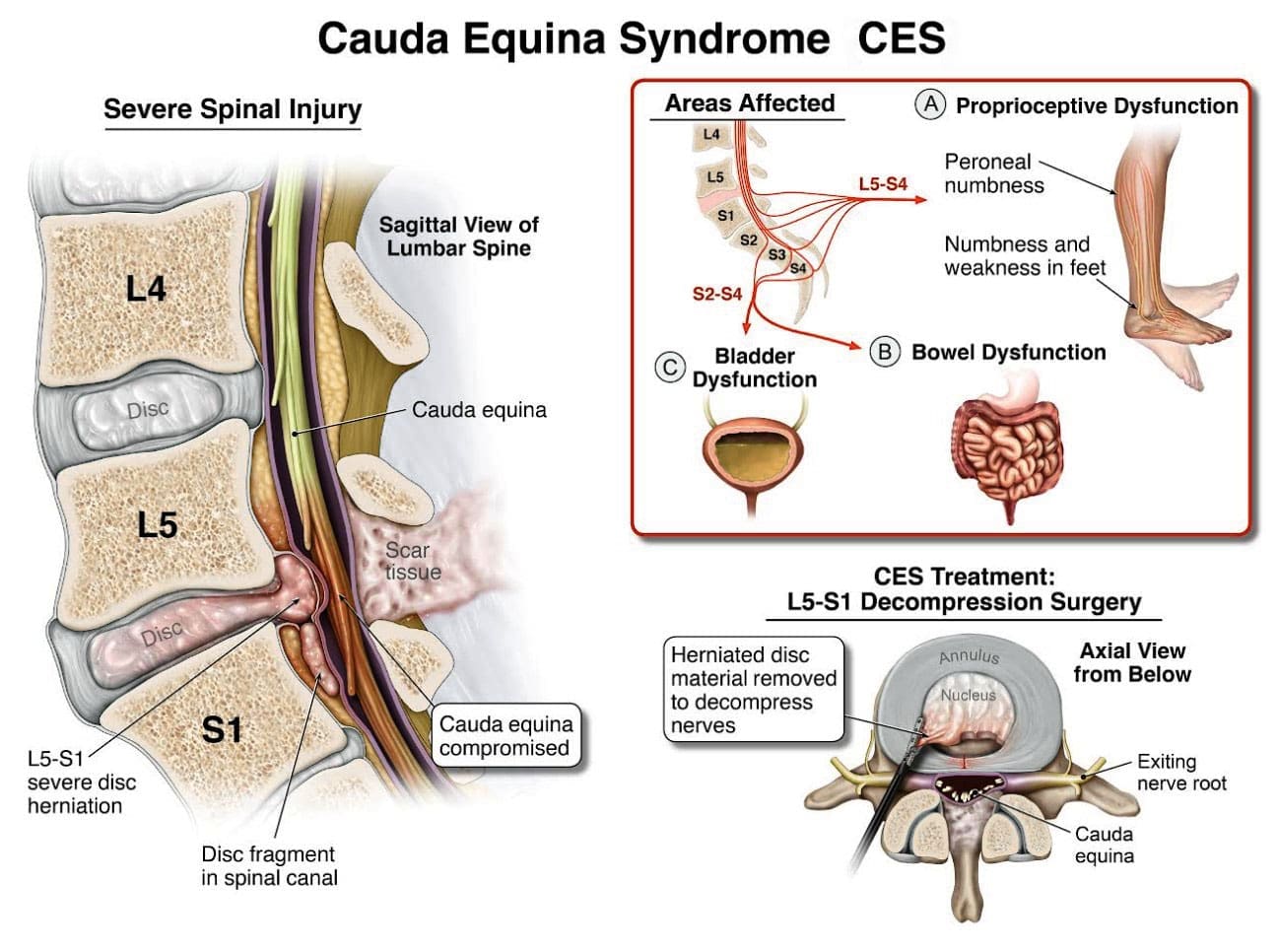 Cauda Equina Compression: Signs to Watch For