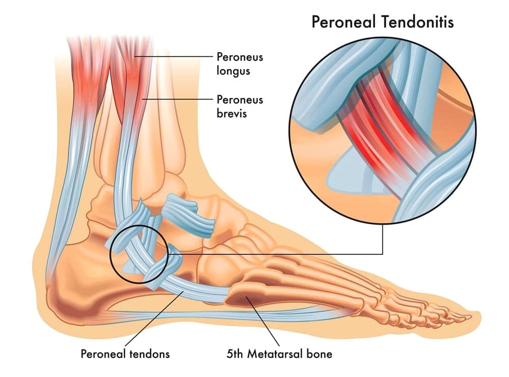 Peroneal Tendon Anatomy and Common Injuries