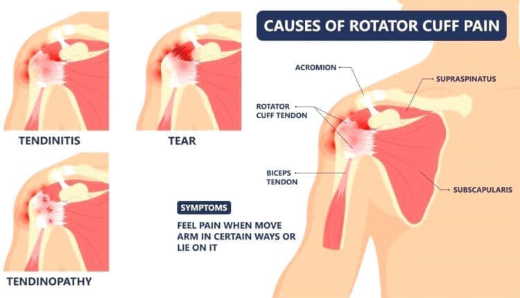 Rotator Cuff Pain: Physical Therapy and Non-surgical Approaches