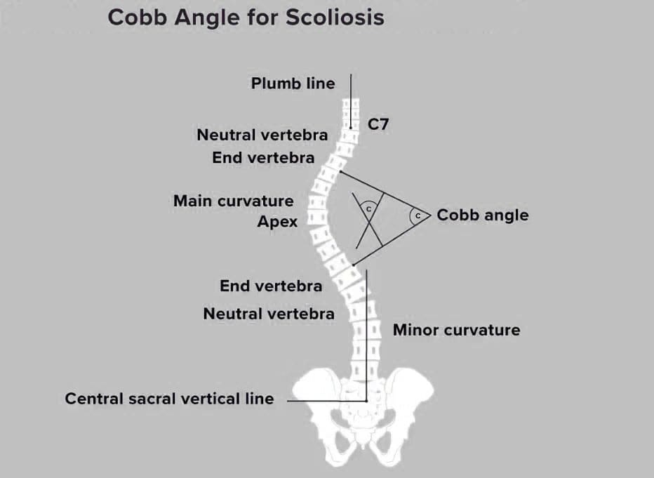 Cobb Angle: How It Guides Treatment Decisions