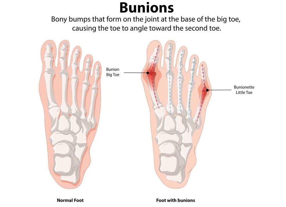 Bunions: Early Signs and Treatment Options