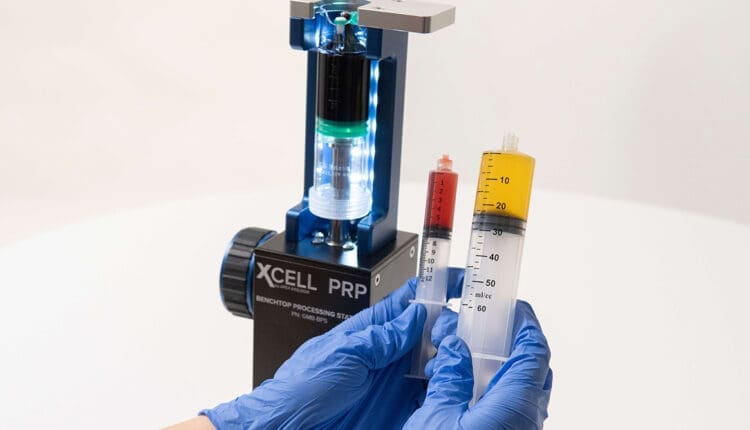 PRP and Chiropractic for Faster Injury Recovery Explained